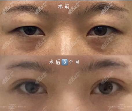 张姣姣双眼皮案例前后对比图1
