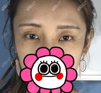 找上海何祥龙双眼皮修复前