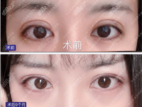 <!--<i data=20240705-sp></i>-->眼修复案例对比图1