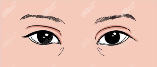 双眼皮失败症状