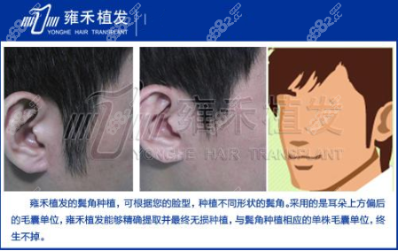 <!--<i data=20240705-sp></i>-->植发鬓角种植效果