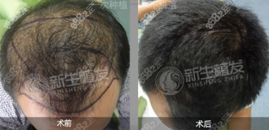 合肥<!--<i data=20240705-sp></i>-->植发头顶加密种植效果图