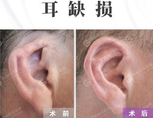 从耳缺损修复案例图片来看,余文林和郑在皓的技术不差上下