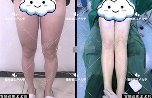 上海丽质卢九宁直腿成形术案例
