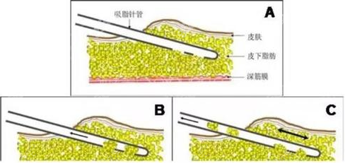 吸脂簡(jiǎn)略圖