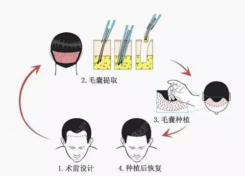 植发手术过程