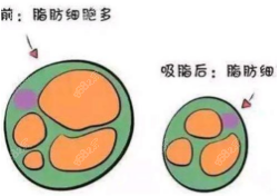 吸脂前后細(xì)胞