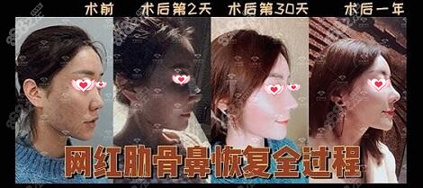 沈阳杏林朱石江肋软骨隆鼻真人案例对比图