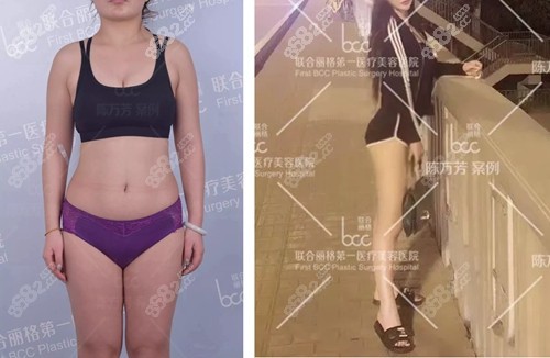 陳萬(wàn)芳醫(yī)生做大腿吸脂術(shù)后半年效果
