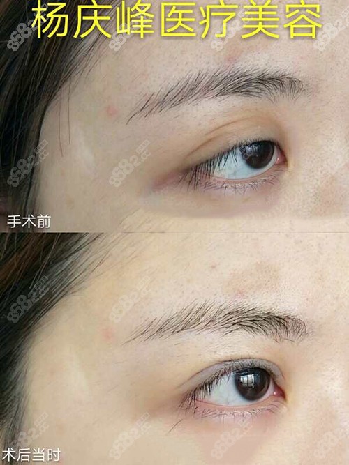 右眼详细修复对比