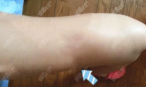 大腿抽脂凹凸不平圖片