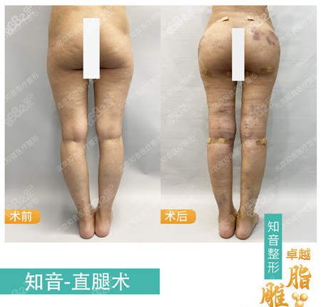 大腿吸脂和脂肪丰臀案例