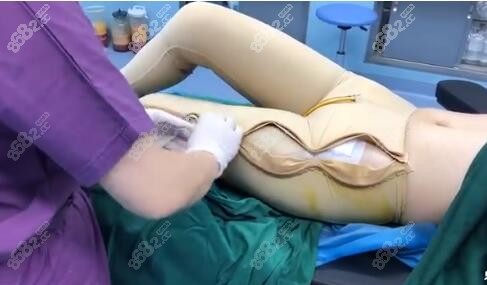 大腿抽脂后穿塑身褲的必要性