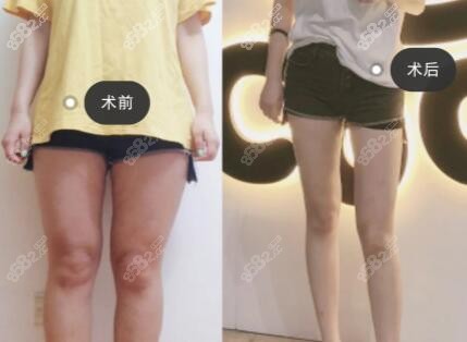 北京達(dá)美如藝大腿吸脂成功案例效果展示