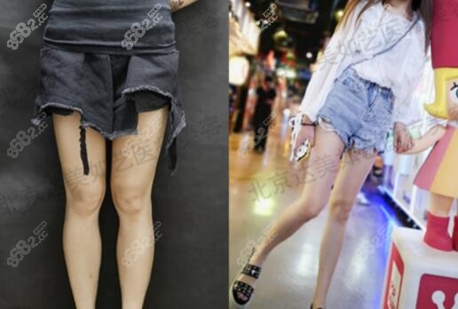 北京達(dá)美如藝大腿環(huán)吸案例效果