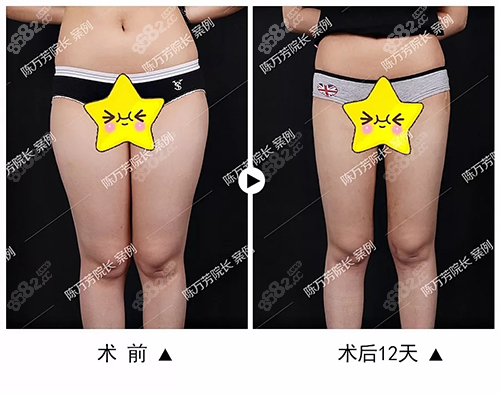 陳萬(wàn)芳醫(yī)生做大腿吸脂案例