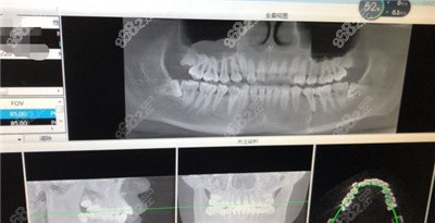 衡阳恒美口腔可视化正畸