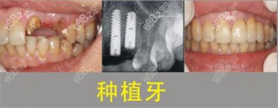 衡阳优牙仕口腔医院种植牙