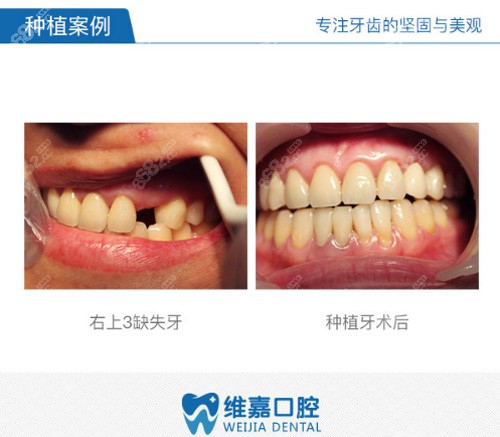 北京维嘉口腔种植牙<span style=