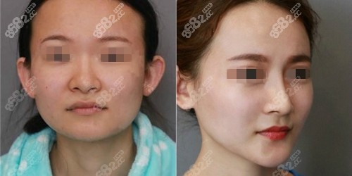 北京米扬丽格假体垫下巴案例