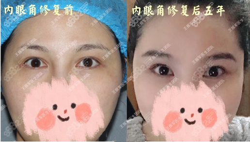 <!--<i data=20240705-sp></i>-->內(nèi)眼角修復(fù)案例圖