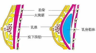 假体隆胸手术术后示意图