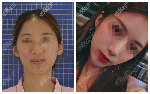 北京艺星假体垫下巴案例