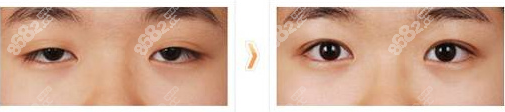 <!--<i data=20240705-sp></i>-->雙眼皮修復(fù)案例圖