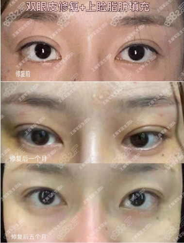 <!--<i data=20240705-sp></i>-->雙眼皮修復(fù)案例圖