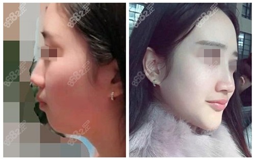 北京华韩假体垫下巴案例