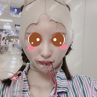 成都友谊李继华磨骨案例谁有?我想看看他磨骨怎么样,颌面对比照-8682