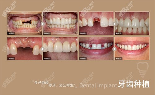 福州<!--<i data=20240705-sp></i>-->口腔种植牙<span style=