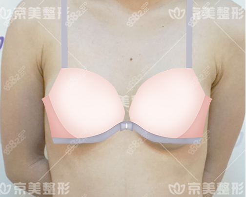 北京京美刘成胜隆胸假体取出胸部形态
