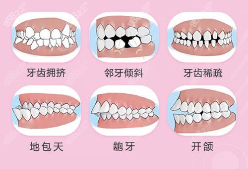 汕头华美整形口腔医院牙齿矫正模拟图