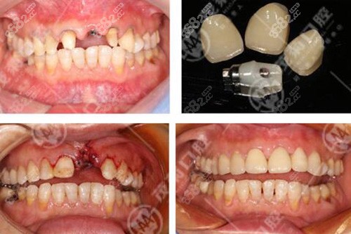 门牙种植 span style=