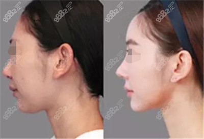 龍口隆鼻<span style= 龍口隆鼻<span style=