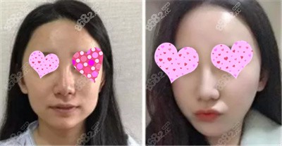 煙臺壹美整形美容醫(yī)院面部填充<span style= 煙臺壹美整形美容醫(yī)院面部填充<span style=