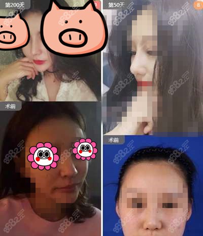 西安画美医疗美容整形隆鼻案例