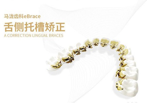 广州马泷齿科舌侧矫正优势