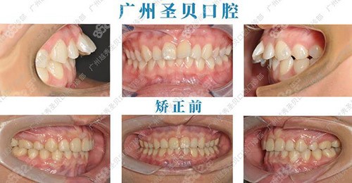 广州圣贝口腔医院正畸<span style=