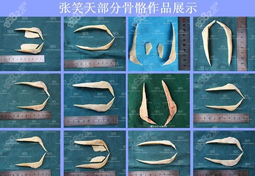 张笑天下颌角磨骨骨骼展示