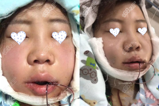 反颌 偏颌在第四军医大口腔做正颌手术的经历,花费不到8万