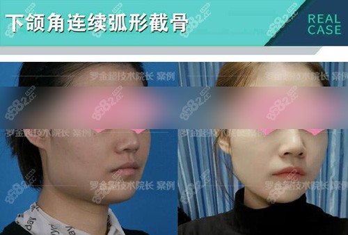 罗金超磨骨对比图