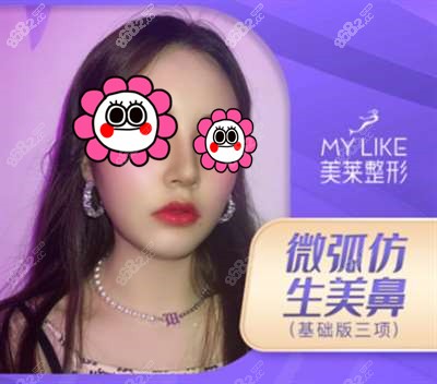 长沙美莱整形医院隆鼻案例