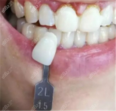 柳州品植口腔牙齿贴片