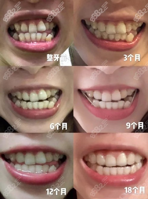 <!--<i data=20240705-sp></i>-->口腔隐形矫正案例