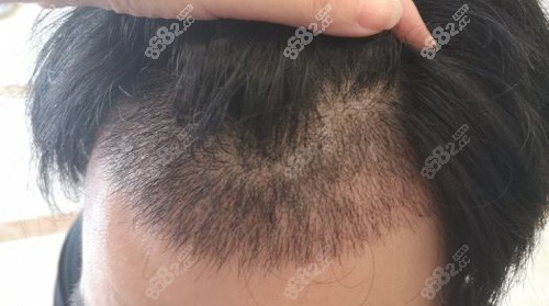 男性植发后毛发生长情况