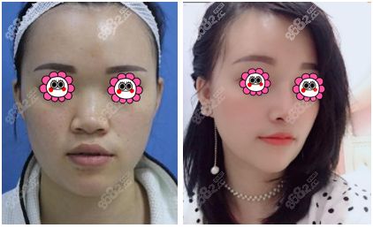 桂林做鼻子好的桂林华美肋骨鼻综合案例效果