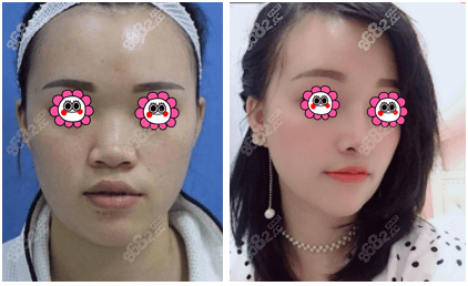 桂林华美肋骨鼻综合案例效果参考