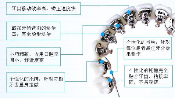 舌侧矫正的优点
